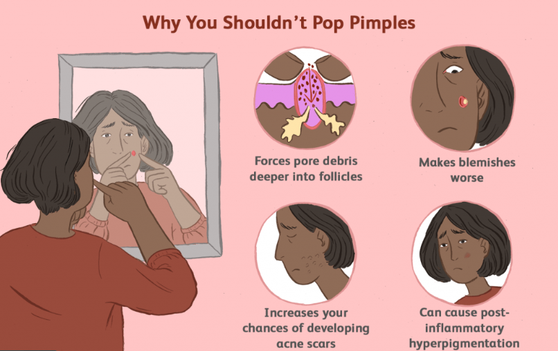 is-popping-pimples-bad-for-my-skin